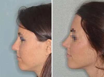 Rhinoplasty before and after, lateral left.