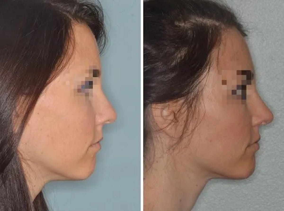 Rhinoplasty before and after, lateral right.