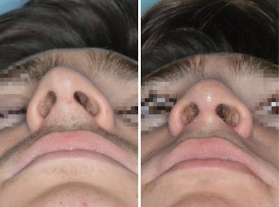 Rhinoplasty before and after, frontal.