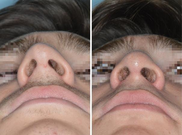 Rhinoplasty before and after, frontal.