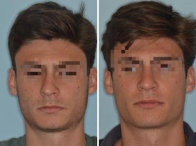 Rhinoplasty before and after, frontal.
