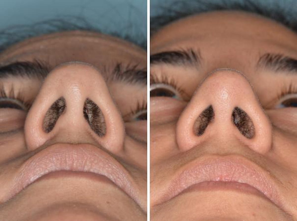Rhinoplasty before and after, frontal.
