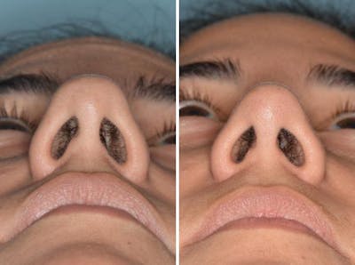 Rhinoplasty before and after, frontal.