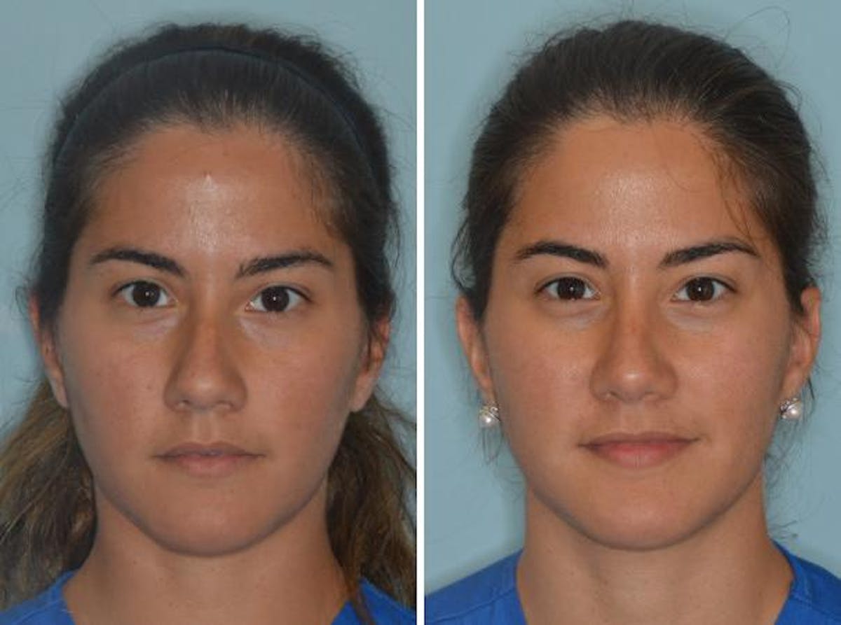 Rhinoplasty before and after, frontal.