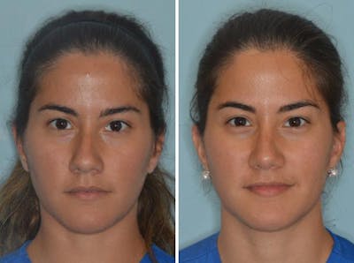 Rhinoplasty before and after, frontal.
