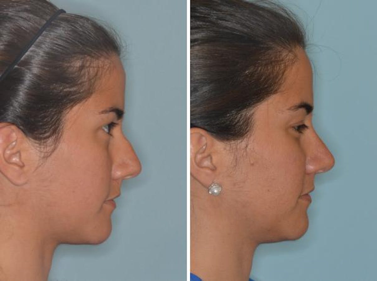 Rhinoplasty before and after, lateral right.