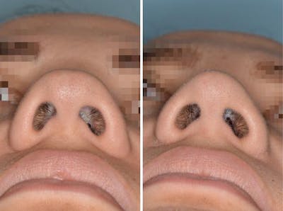 Rhinoplasty before and after, frontal.