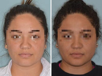 Rhinoplasty before and after, frontal.