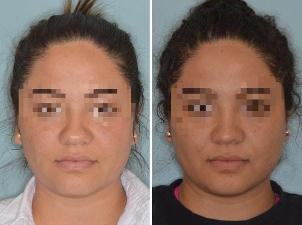 Rhinoplasty before and after, frontal.