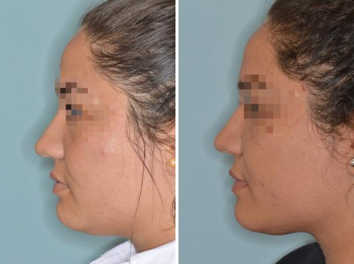 Rhinoplasty before and after, lateral left.