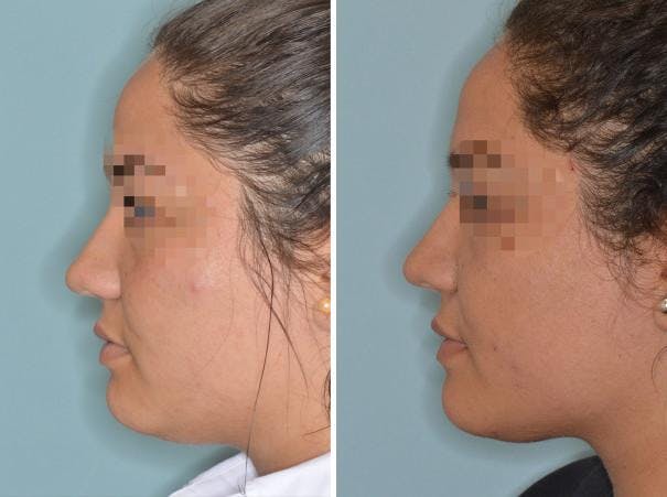 Rhinoplasty before and after, lateral left.