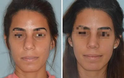 Rhinoplasty before and after, frontal.