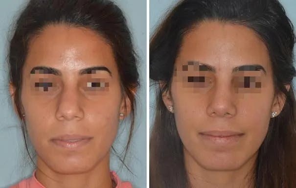 Rhinoplasty before and after, frontal.