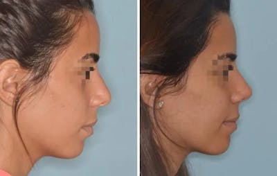 Rhinoplasty before and after, lateral right.