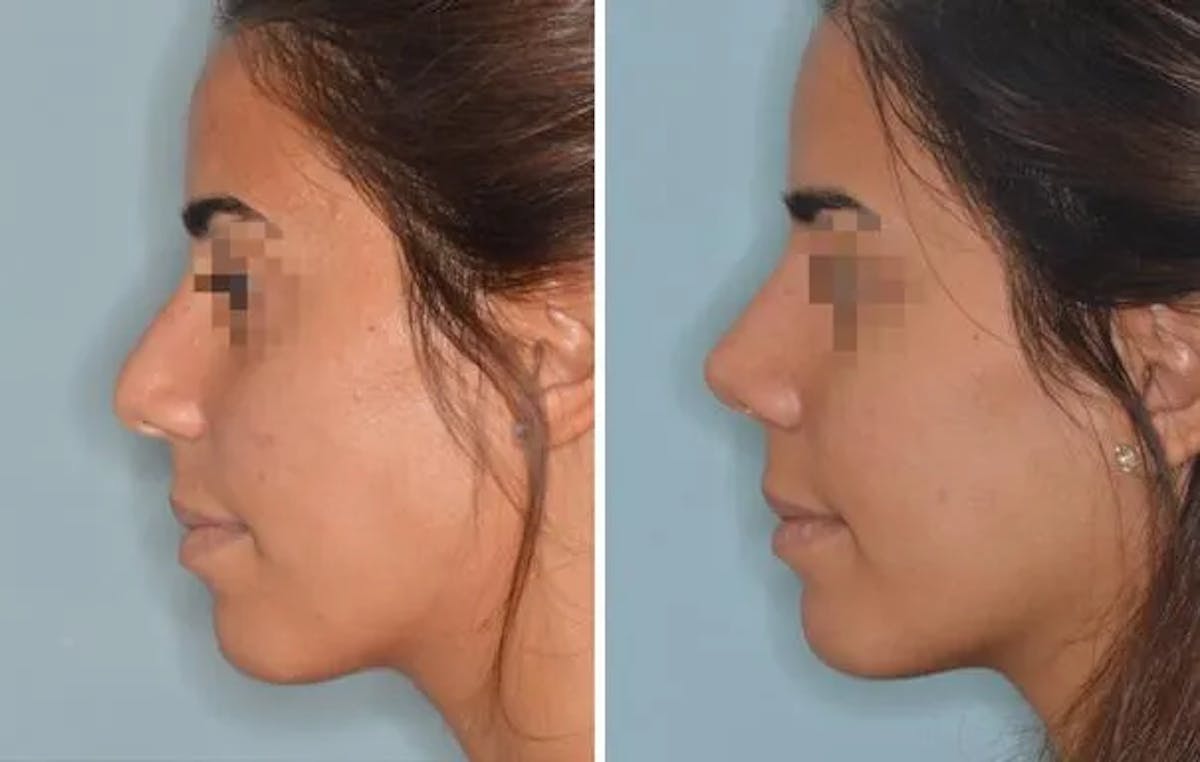 Rhinoplasty before and after, lateral left.