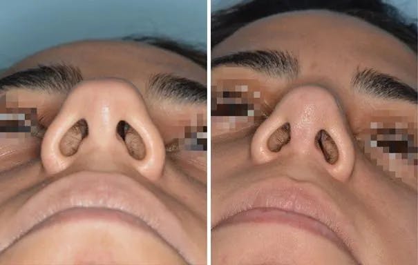 Rhinoplasty before and after, frontal.