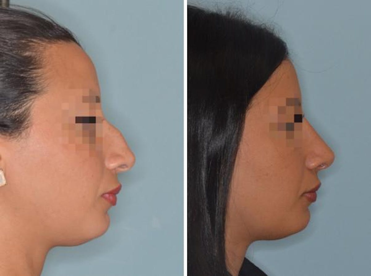 Rhinoplasty before and after, lateral right.