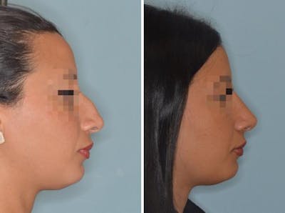 Rhinoplasty before and after, lateral right.