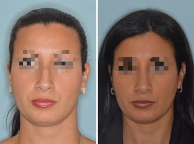 Rhinoplasty before and after, frontal.