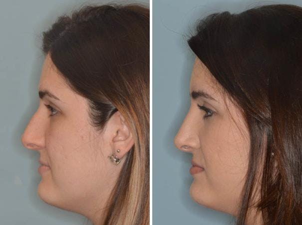 Rhinoplasty before and after, lateral left.