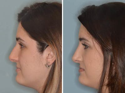 Rhinoplasty before and after, lateral left.