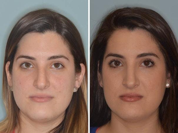 Rhinoplasty before and after, frontal.