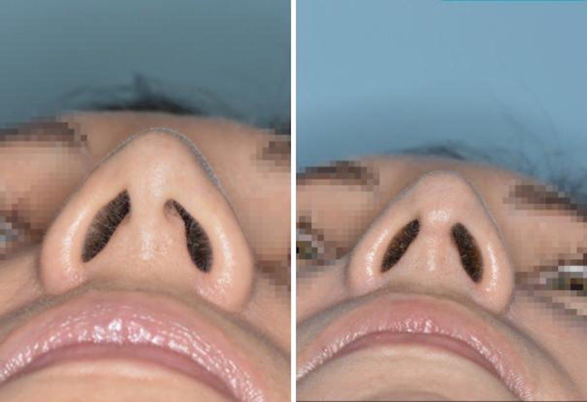 Rhinoplasty before and after, frontal.
