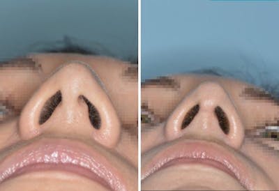 Rhinoplasty before and after, frontal.