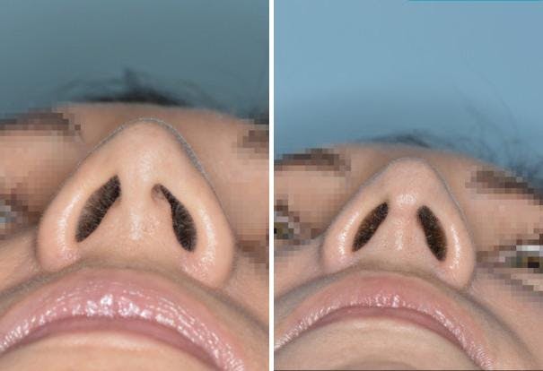 Rhinoplasty before and after, frontal.
