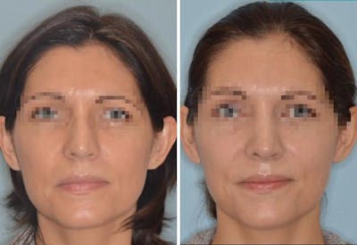 Rhinoplasty before and after, frontal.