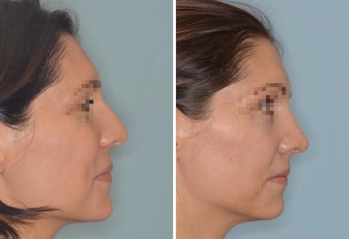 Rhinoplasty before and after, lateral right.