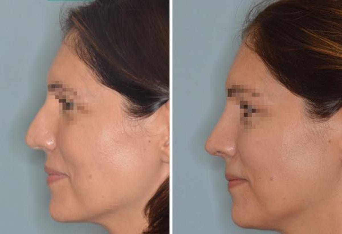 Rhinoplasty before and after, lateral left.