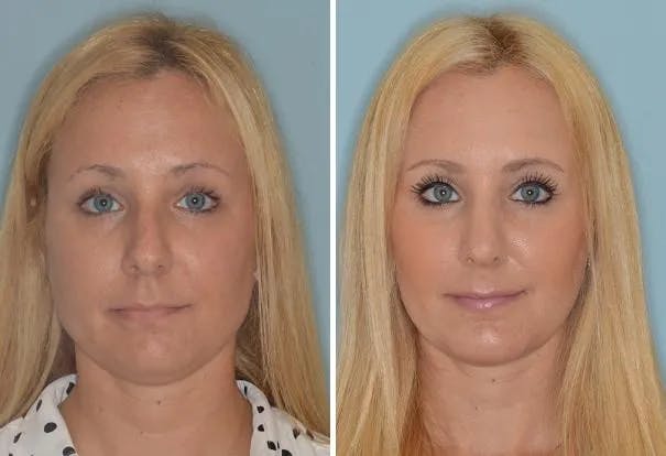 Rhinoplasty before and after, frontal.