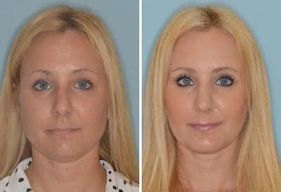 Rhinoplasty before and after, frontal.