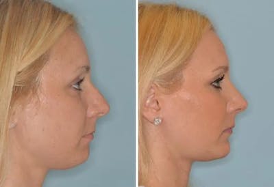 Rhinoplasty before and after, lateral right.