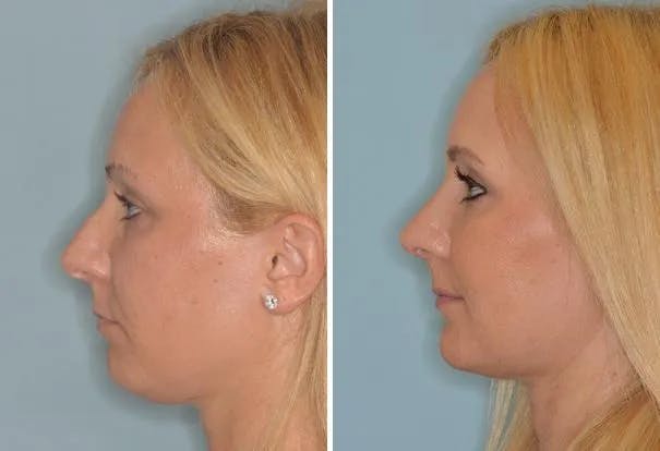 Rhinoplasty before and after, lateral left.