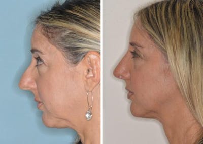 Rhinoplasty before and after, lateral left.