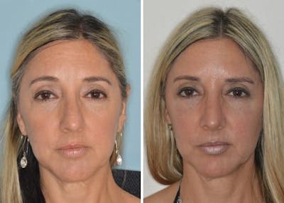 Rhinoplasty before and after, frontal.