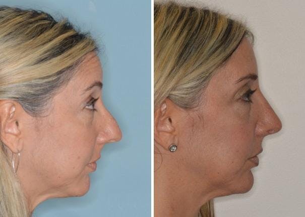 Rhinoplasty before and after, lateral right.