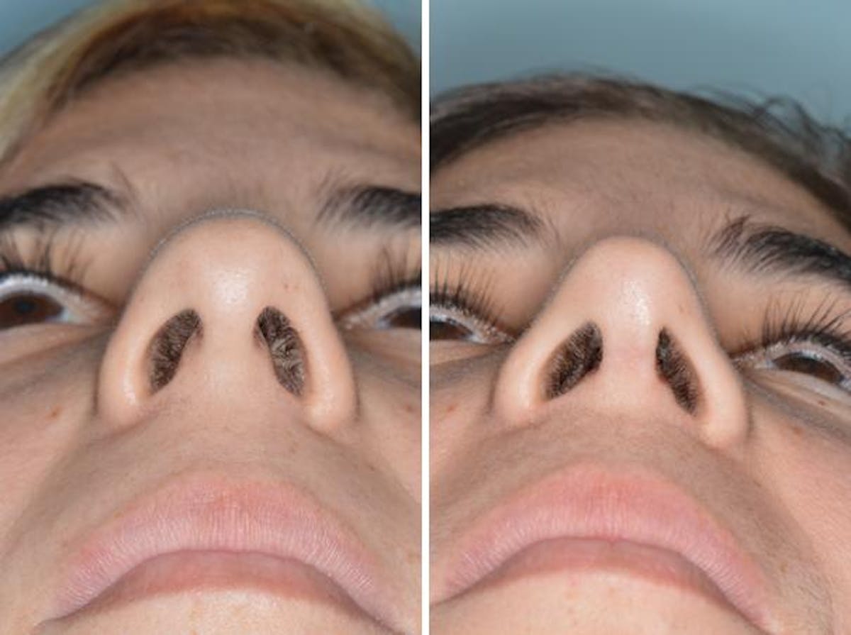 Rhinoplasty before and after, frontal.