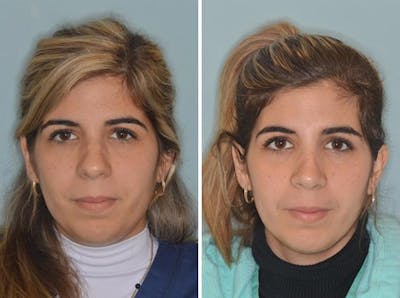 Rhinoplasty before and after, frontal.