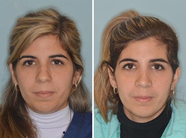 Rhinoplasty before and after, frontal.