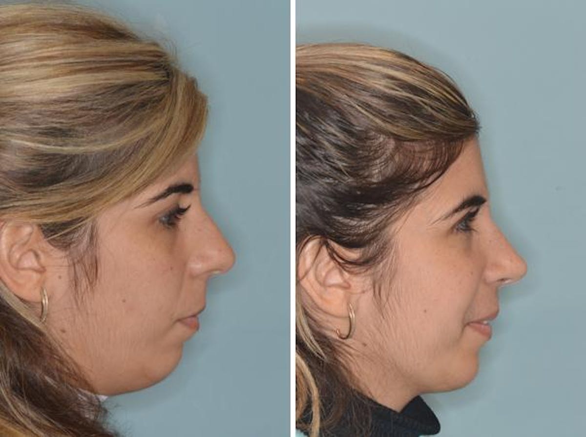 Rhinoplasty before and after, lateral right.
