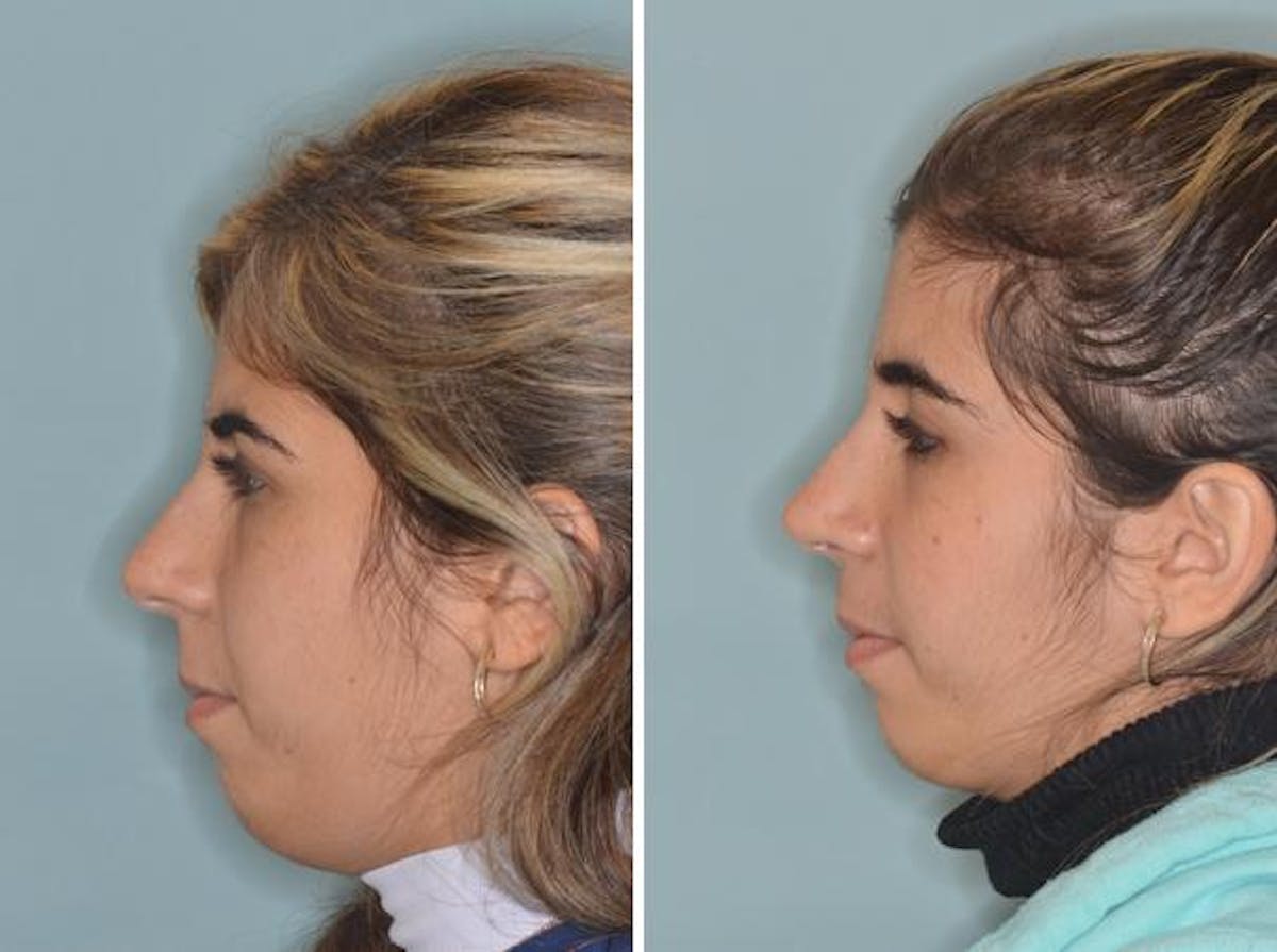 Rhinoplasty before and after, lateral left.