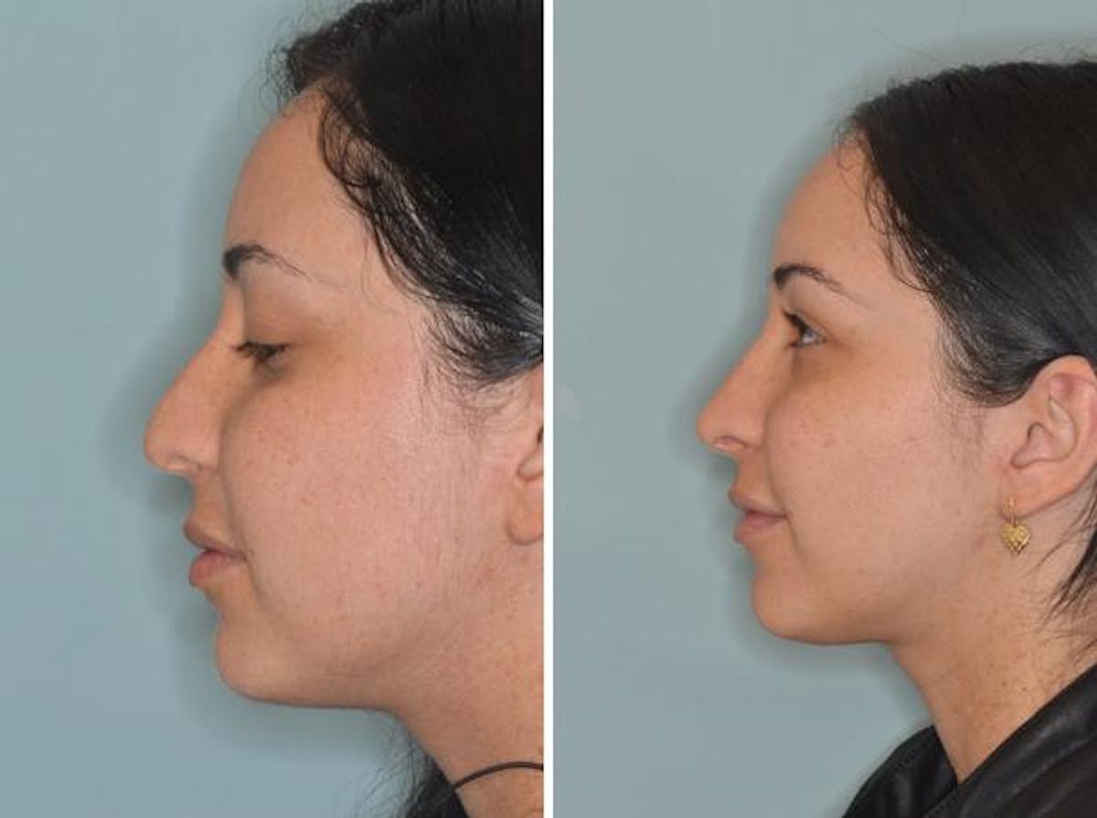 Rhinoplasty before and after, lateral left.
