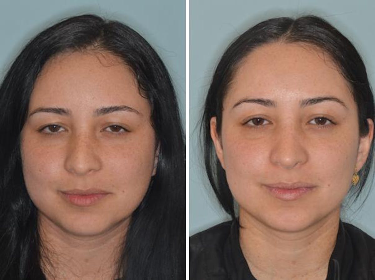 Rhinoplasty before and after, frontal.