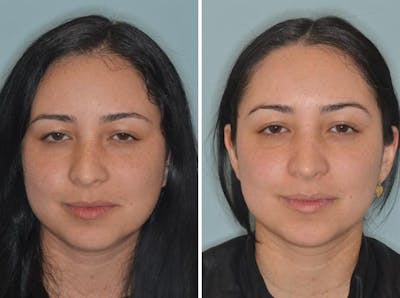 Rhinoplasty before and after, frontal.