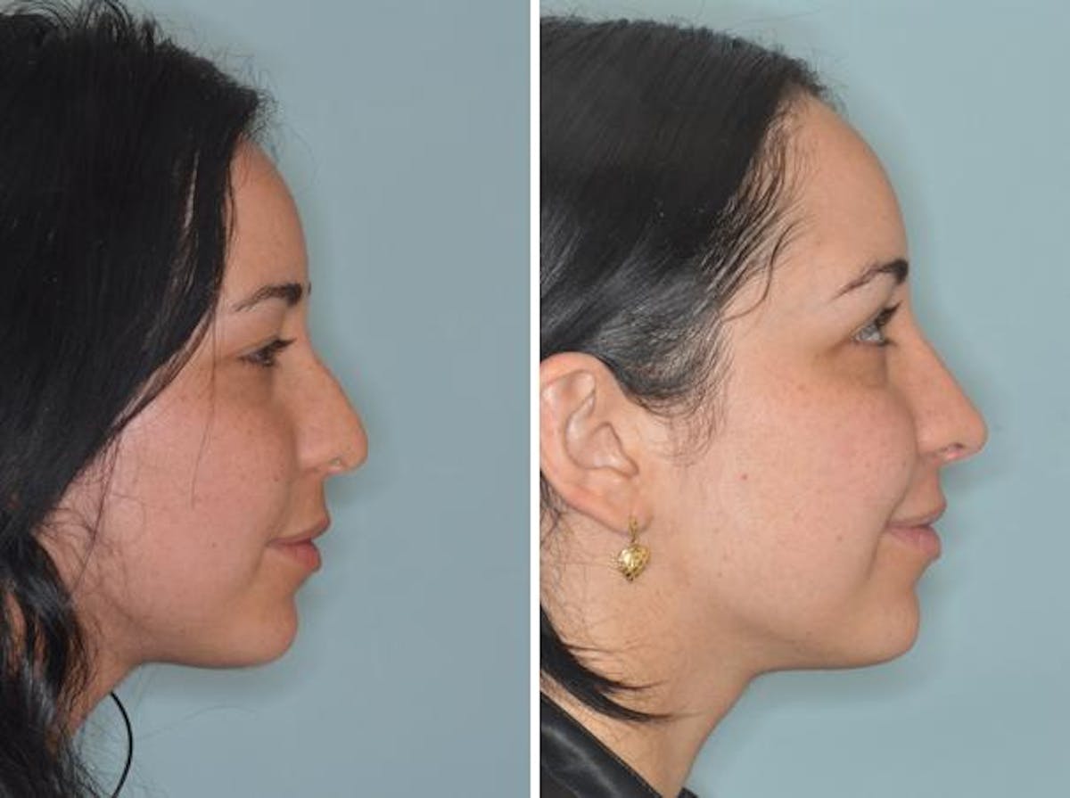 Rhinoplasty before and after, lateral right.