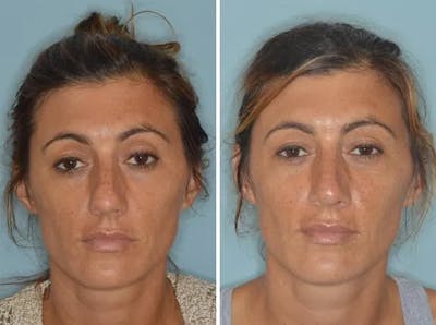 Rhinoplasty before and after, frontal.
