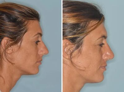 Rhinoplasty before and after, lateral right.